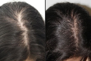 using rogaine to thicken hair